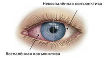 Рис.5. Конъюнктивит - заболевание глаз